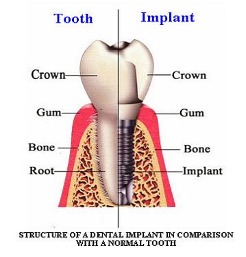 dental implant abutment